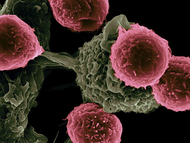 Tế bào ung thư trong cơ thể con người
